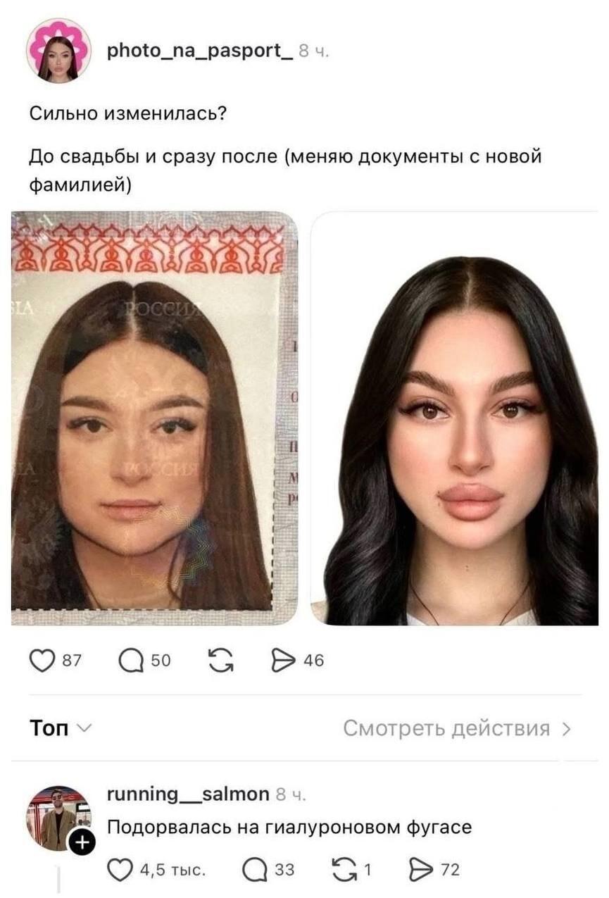 До и после свадьбы: гиалурон изменил жену до неузнаваемости?